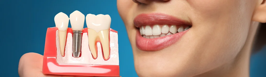 Single-Tooth Implants in Nashville TN