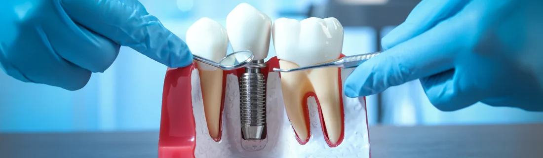 Types of Dental Implants in Nashville TN
